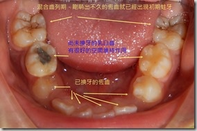 混合齒列期