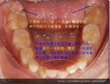 牙齦覆蓋齒面