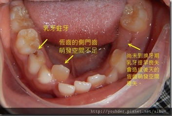 1乳牙萌出空間不足 乳牙蛀牙