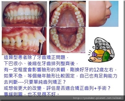 牙齒先天的臉形會影響矯正結果