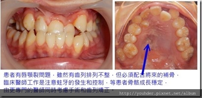 齒列矯正配合手術