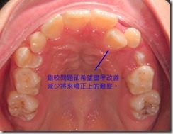 乳牙期的矯正考量-4