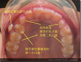 兒童換牙期的問題