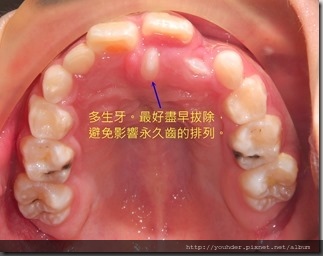 乳牙期的矯正考量3-3-1