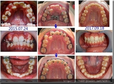 牙齒排列問題1
