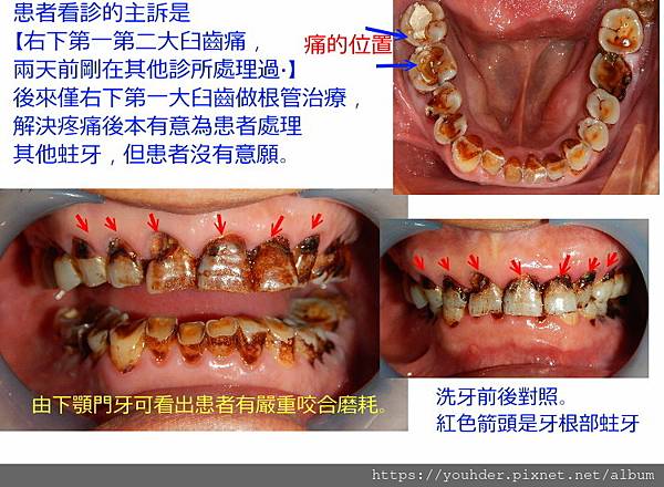 蛀牙+磨耗.jpg