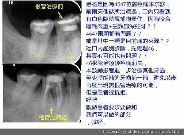 根管前後對照.jpg