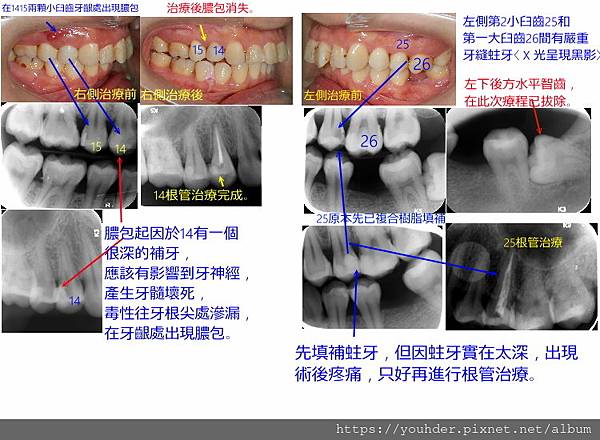 更新患者口內補牙〈同一患者，續〉.jpg