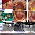 完整處理口內牙齒問題，僅自費牙套未執行.jpg