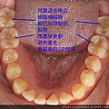 補綴物更新.jpg