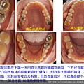 崇先更新補綴物.jpg