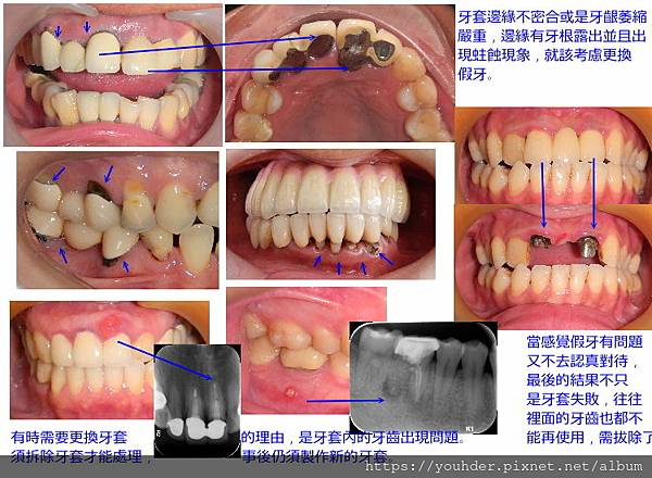 假牙何時須更換.jpg