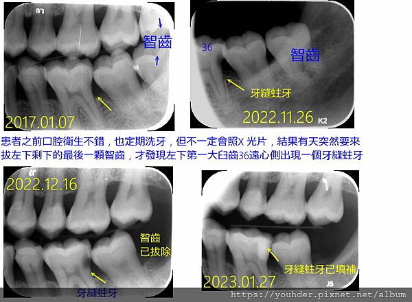 拔智齒發現牙縫蛀牙.jpg