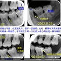 拔智齒發現牙縫蛀牙.jpg