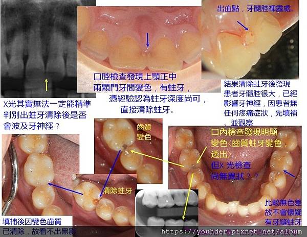 X光檢查不一定看出牙縫蛀牙.jpg