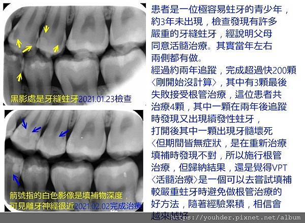 我的第一顆活髓治療紀錄2021.02.02.jpg