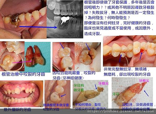 各種牙裂.jpg