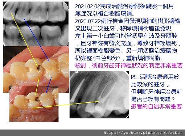 我的第一顆活髓治療紀錄兩年後追蹤.jpg