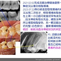 我的第一顆活髓治療紀錄兩年後追蹤.jpg