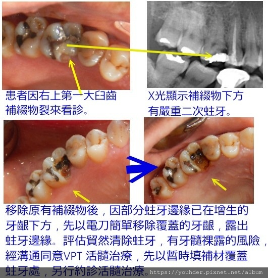 活髓治療說明.jpg