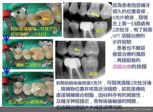 活髓治療紀錄2021.02.06.jpg