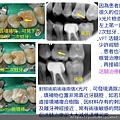 活髓治療紀錄2021.02.06.jpg