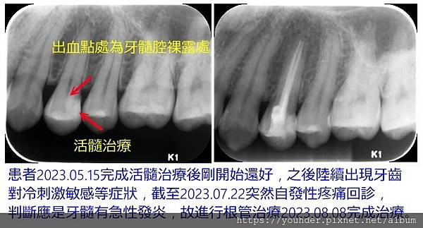 活髓治療中有出血後失敗1.jpg