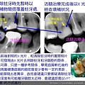 活髓治療說明2.jpg