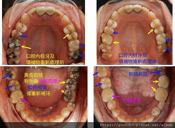 活髓治療說明5.jpg