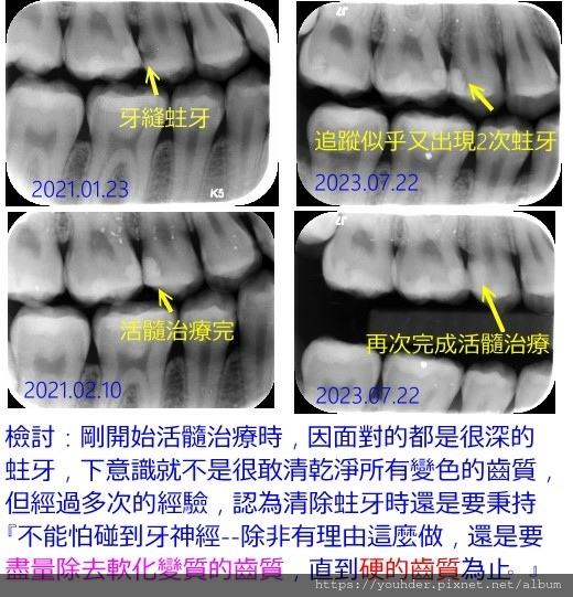 活髓治療說明8.jpg