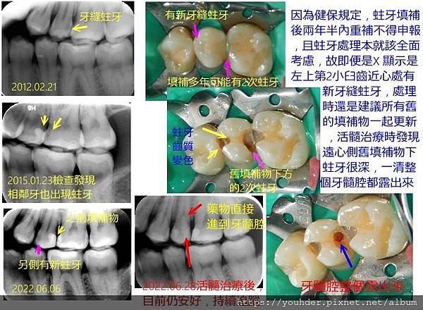 活髓治療說明7.jpg