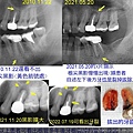 根管多年後牙根裂掉.jpg