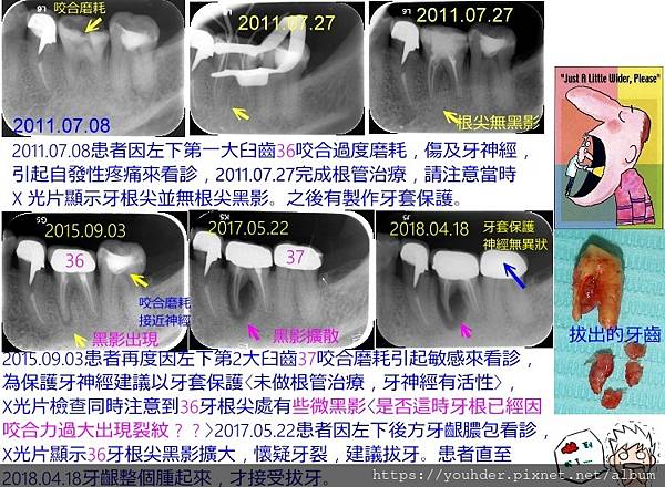 根管多年後牙根裂掉1.jpg