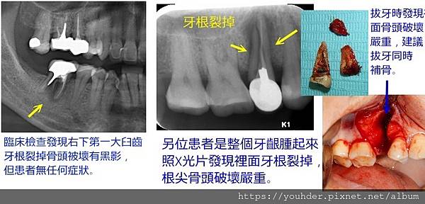 根管後多年牙根裂掉.jpg