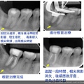 蛀牙太深補牙後出現牙髓壞死1.jpg