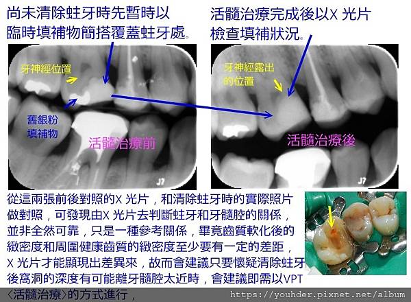 活髓治療說明2.jpg