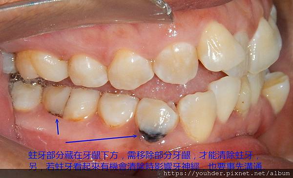 牙齦下蛀牙.jpg