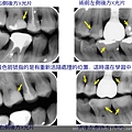 活髓治療說明4.jpg