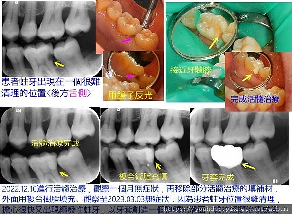 活髓治療說明10.jpg