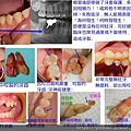 各種牙裂.jpg