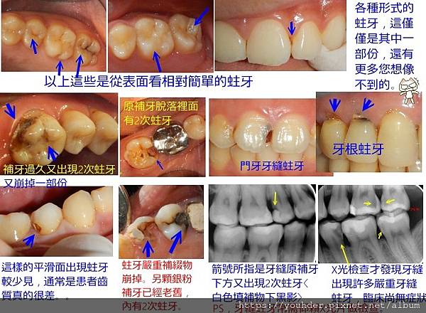 1各種蛀牙形式2024.12.18.jpg
