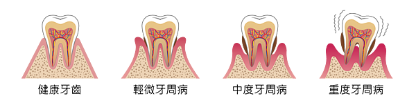 牙周病竟然會影響關節炎 植牙族群千萬要小心