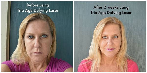 before-and-after-tria-2-weeks