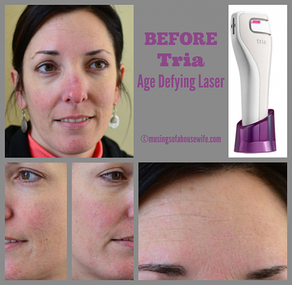 BEFORE-Tria-Age-Defying-Laser-620x603