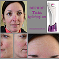 BEFORE-Tria-Age-Defying-Laser-620x603