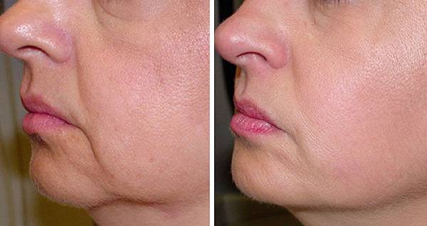 Thermage-Face-before-and-after_l