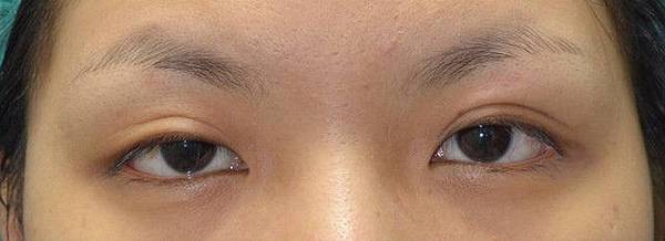 【案例照片】苏毓彬医师│双眼皮手术-提眼脸肌无力术前术后1个月