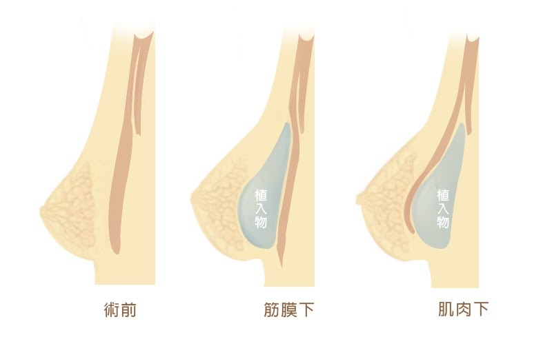 義乳放置位置_肌肉下、筋膜下.jpg