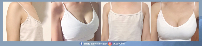 產後隆乳-術後3個月.jpg