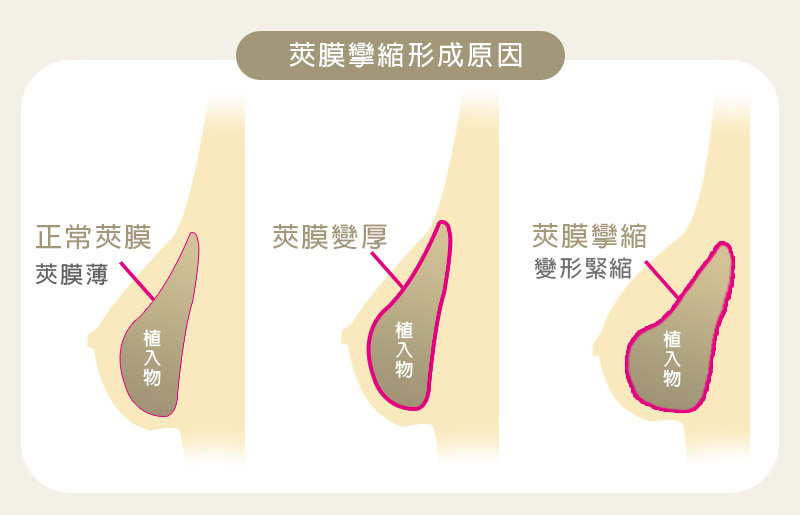 隆乳失敗，莢膜攣縮形成原因.jpg